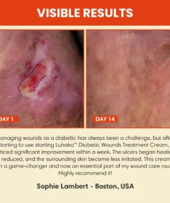 Luhaka™ Diabetic Wounds Treatment Cream