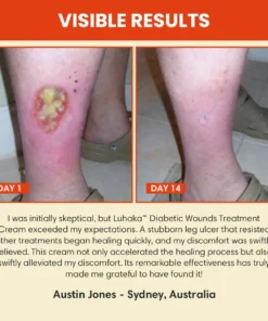 Luhaka™ Diabetic Wounds Treatment Cream