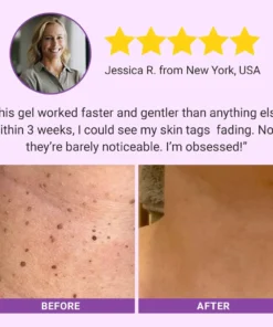Luhaka® DermaClear Mole and Dark Spot Removal Bio-Gel