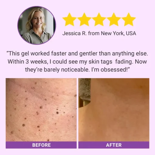 Luhaka® DermaClear Mole and Dark Spot Removal Bio-Gel