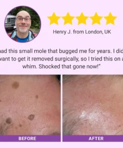 Luhaka® DermaClear Mole and Dark Spot Removal Bio-Gel