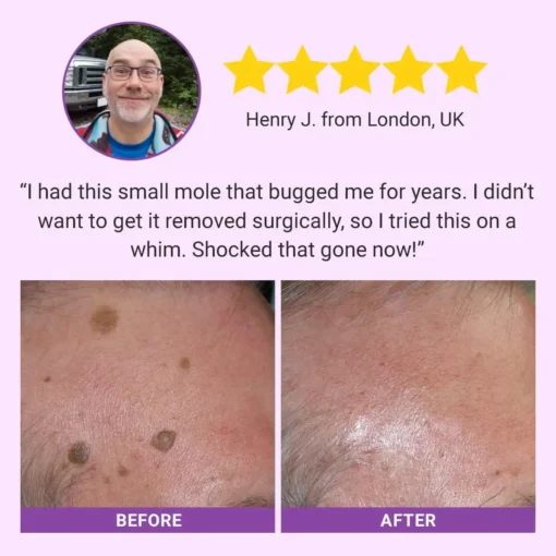 Luhaka® DermaClear Mole and Dark Spot Removal Bio-Gel