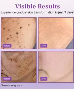 Luhaka® DermaClear Mole and Dark Spot Removal Bio-Gel