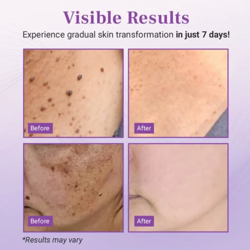 Luhaka® DermaClear Mole and Dark Spot Removal Bio-Gel
