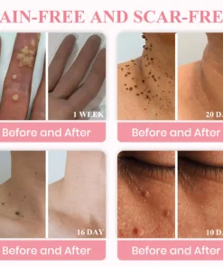 LUHAKA® Dual Acid Wart & Mole Removal Serum