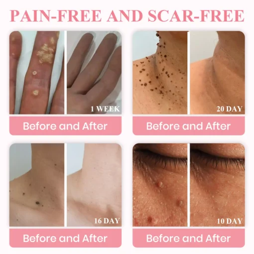 LUHAKA® Dual Acid Wart & Mole Removal Serum