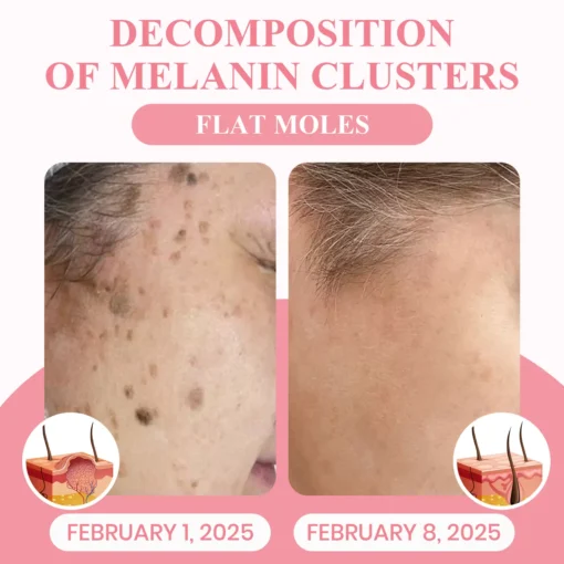LUHAKA® Dual Acid Wart & Mole Removal Serum