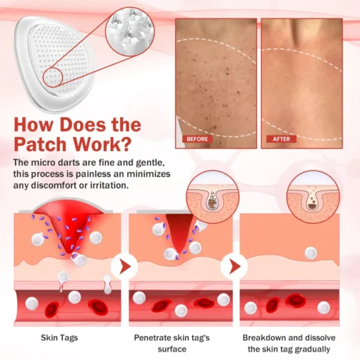 Luhaka® PureSkin Microneedle Botanic Skin Tag Removal Patch