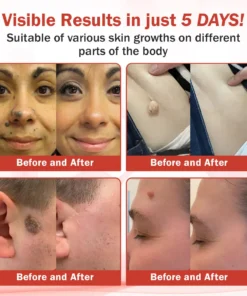 Luhaka® PureSkin Microneedle Botanic Skin Tag Removal Patch