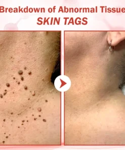 Luhaka® PureSkin Microneedle Botanic Skin Tag Removal Patch