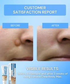 Luhaka® Clear Away Wax Warts Removal