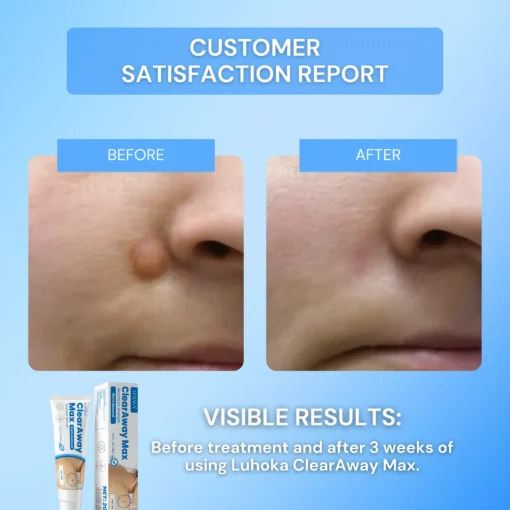 Luhaka® Clear Away Wax Warts Removal