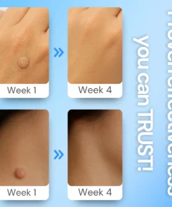 Luhaka® Clear Away Wax Warts Removal