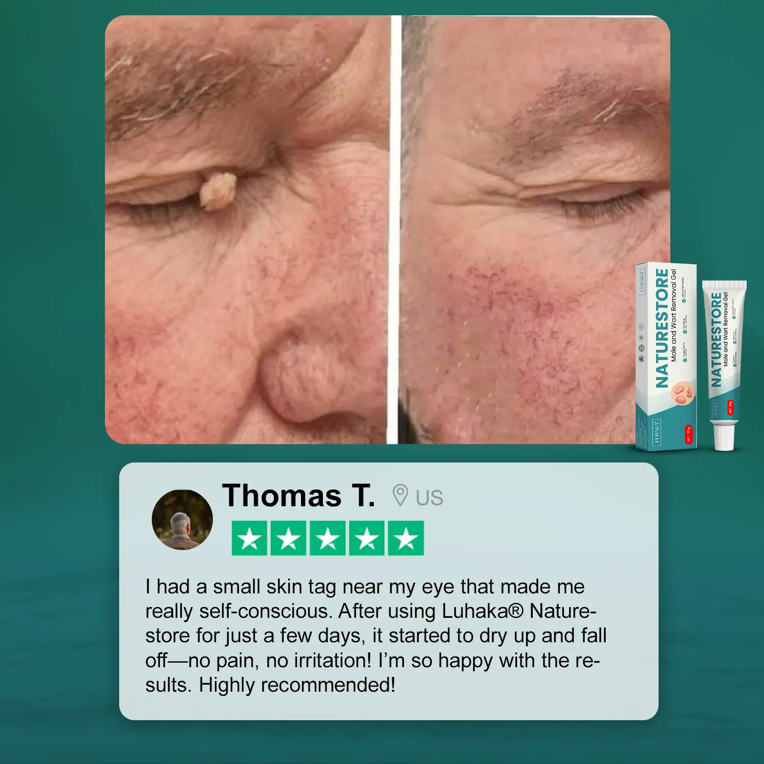 Luhaka® Naturestore Mole and Wart Removal GelUltra03