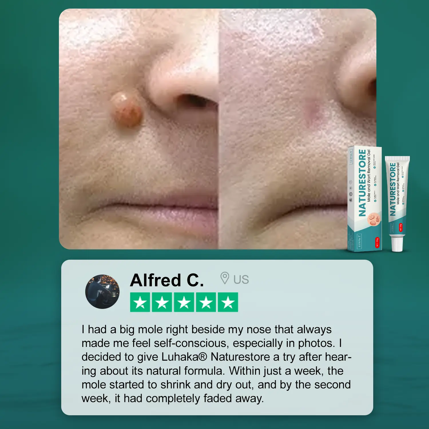 Luhaka® Naturestore Mole and Wart Removal GelUltra03