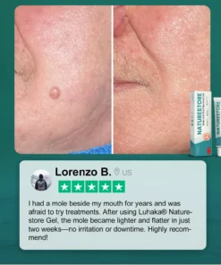 Luhaka® Naturestore Mole and Wart Removal GelUltra03