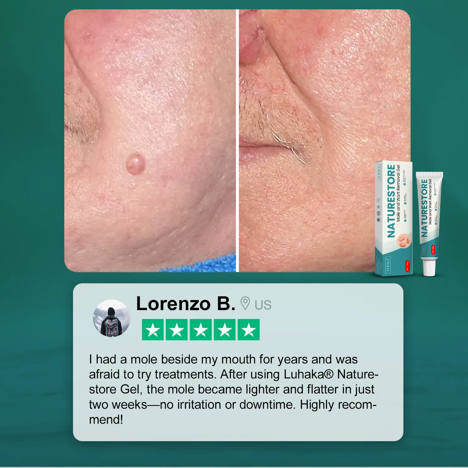 Luhaka® Naturestore Mole and Wart Removal GelUltra03