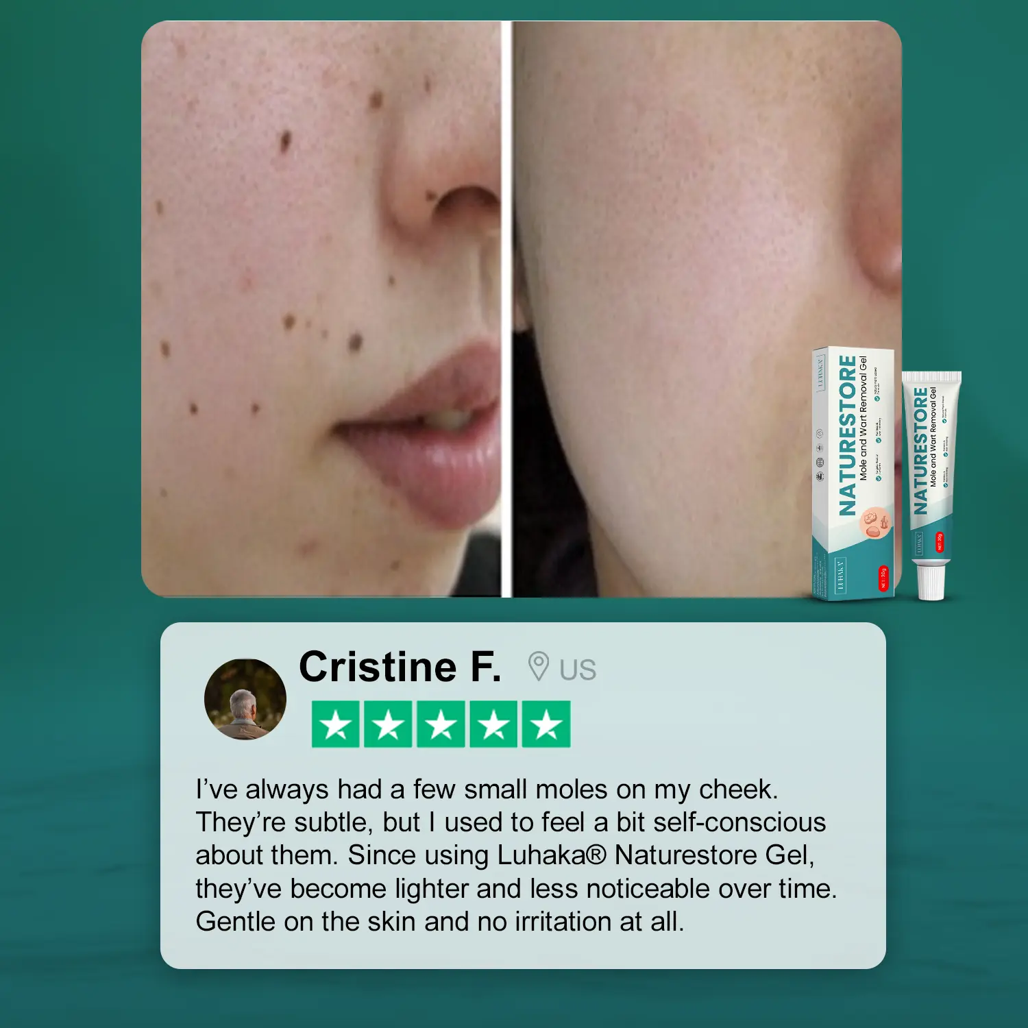 Luhaka® Naturestore Mole and Wart Removal GelUltra03