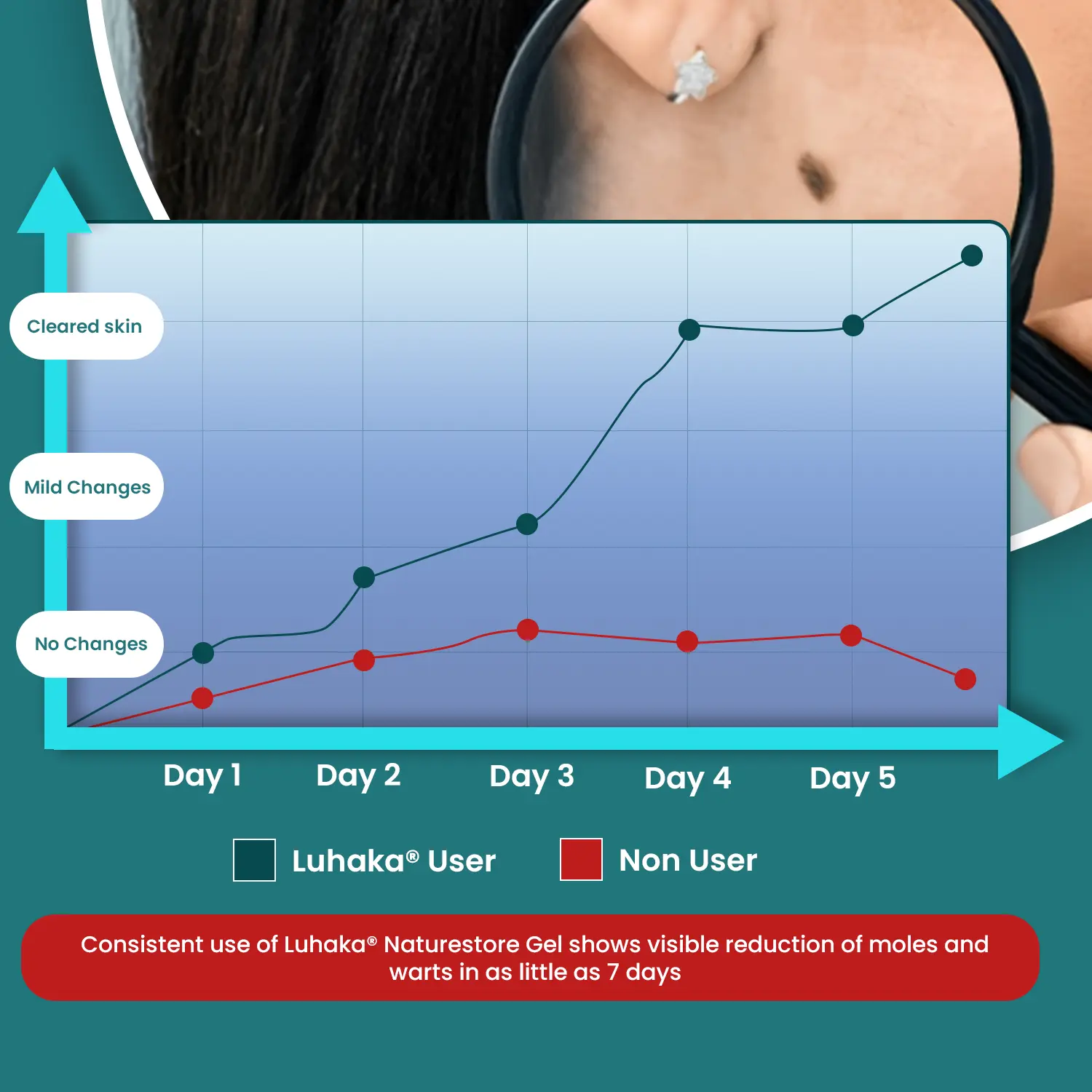 Luhaka® Naturestore Mole and Wart Removal GelUltra03
