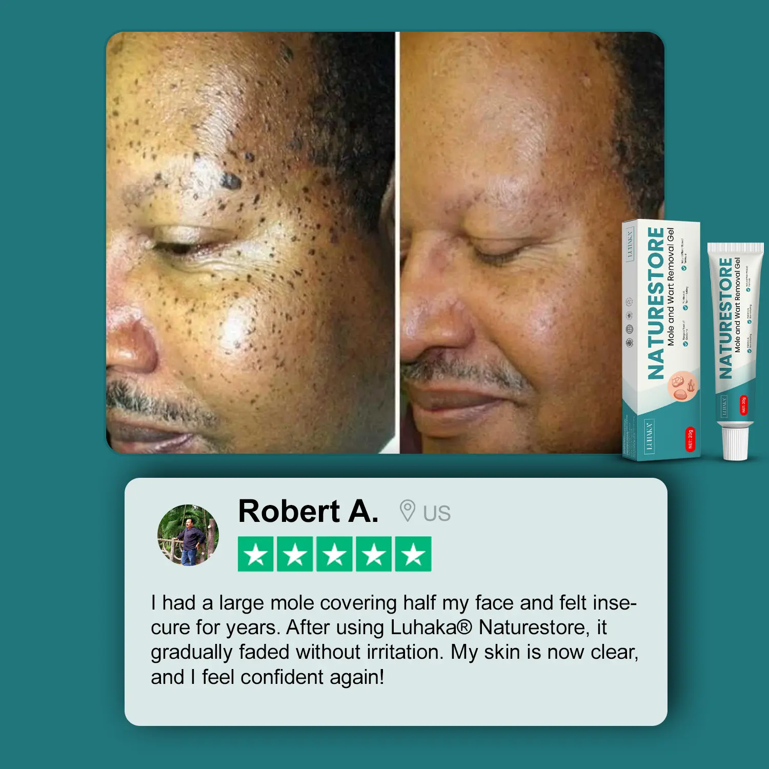 Luhaka® Naturestore Mole and Wart Removal GelUltra03