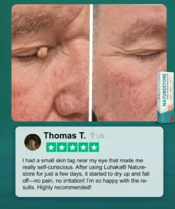 Luhaka® Naturestore Mole and Wart Removal GelUltra04