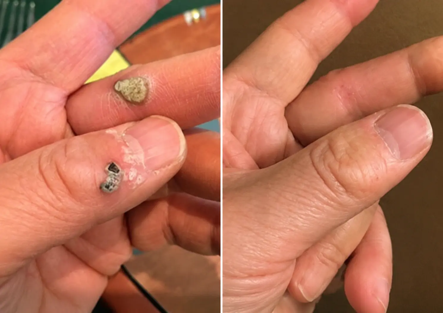 Luhaka® 2-in-1 Microneedle & Hydrocolloid Patch